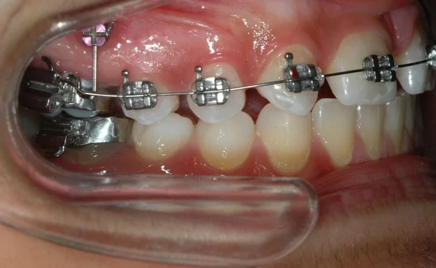 Orthodontic Anchorage System