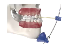 S16 Invisible Forwarding Traction Device